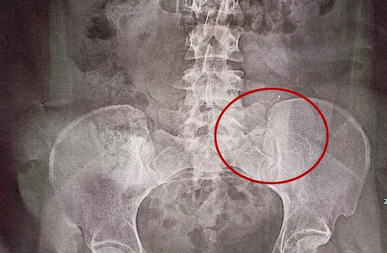 Três meses após cesárea, mulher passa por cirurgia para retirar corpo estranho do abdômen em Toledo