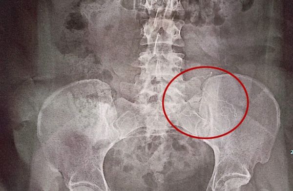 Três meses após cesárea, mulher passa por cirurgia para retirar corpo estranho do abdômen em Toledo